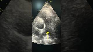 quot¿Qué revela la arteria pulmonar en una ecocardiografía 🌬️ Descúbrelo en 60 segundos Medicinaquot [upl. by Sunderland]