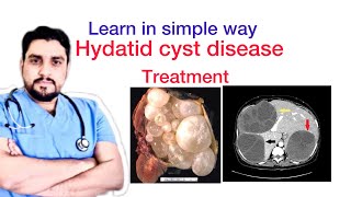 Hydatid cyst disease of liverTreatment [upl. by Novahs]