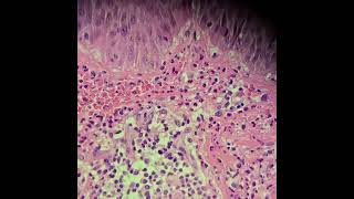 Vasculite leucocitoclástica vasculitis dermatopathology skinbiopsy legulcers [upl. by Blaire513]