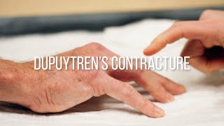 Dupuytrens Contracture Explained Symptoms Causes and Treatments [upl. by Gilson]