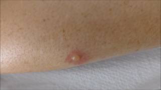 blisters from mosquito bites  before and after treatment [upl. by Weitzman]