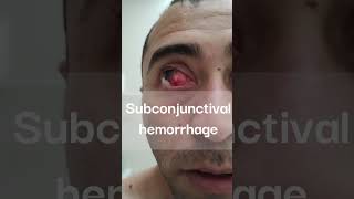 Subconjunctival hemorrhage ophthalmology hemorrhage health [upl. by Anotal448]