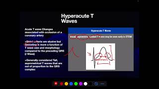 Hyperacute T Waves as a STEMI Equivalent [upl. by Azilanna329]