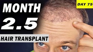 FUE Hair Transplant 25 MONTHS post op Istanbul Turkey [upl. by Hyrup390]