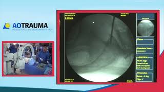 Percutaneous insertion of S1 iliosacral screw Mr Anthony Ward [upl. by Neivad]