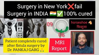 fistula surgery day 37patient completely cured after fistula surgery by dr pankaj gargfistulainano [upl. by Allyce]