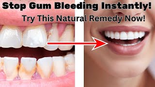 Stop Gum Bleeding Instantly Try This Natural Remedy Now [upl. by Best]