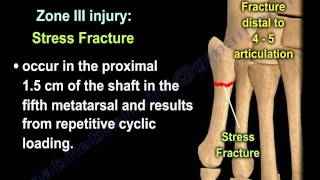 Proximal Fifth Metatarsal Fractures  Everything You Need To Know  Dr Nabil Ebraheim [upl. by Beutner]