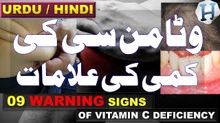 Vitamin C Benefits  Vitamin C Deficiency Symptoms amp Vitamin C Rich Foods  Health Tips Urdu Hindi [upl. by Ahtabbat]