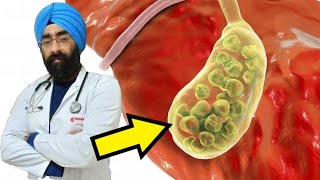 What are Gallstones Bilestone Calculus Gall Bladder Concretion Cystolith  DrEducation Hindi Eng [upl. by Elwin]