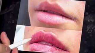 NO DISSOLVE LIP FILLER ANALYSIS [upl. by Ettellocin]