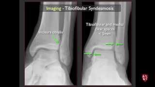 Imaging of the Tibiofibular Syndesmosis and High Ankle Sprain [upl. by Colleen]