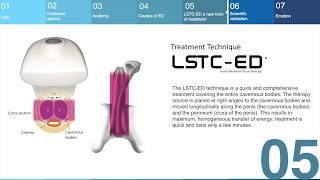 Treatment of Erectile Dysfunction with Linear Shockwaves LSTCED technique [upl. by Holman]