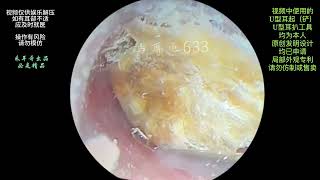 采耳哥The ear canal is blocked by large pieces of fungal earwax for cleaning [upl. by Ecinaj713]