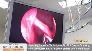 Septoplasty To Correct Chronic Sinusitis  3102860123 [upl. by Jillie]