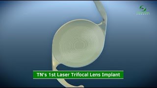 1st Laser Trifocal Lens Implant in Tennessee [upl. by Flin563]