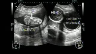 Ultrasound video of Cystic Hygroma [upl. by Georgy]