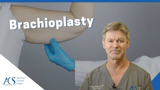 Brachioplasty Surgery Explained By Plastic Surgeon What is it Scars Recovery and More [upl. by Hogg]