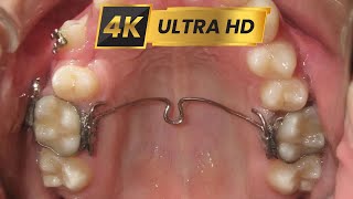 HOW BRACES WORK  TransPalatal Arch and crisscross elastics in 4k [upl. by Etteroma]