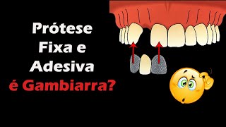 Prótese Fixa e Prótese Adesiva  Vale a Pena Dentista Responde Dúvidas Sobre Estes Tratamentos [upl. by Adidnere971]