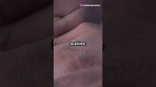 Scabies Uncovered Prevention and Management health facts youtuber science skincare foryou [upl. by Anan]