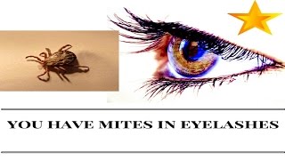 You have mites on your eyelashes [upl. by Carleton]