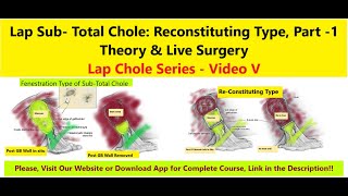 SubTotal Cholecystectomy Series Part 13 Reconstituting amp Fenestration cholecystectomy [upl. by Sirroned]