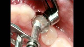 Amalgam Fillings Procedure  Lake Merritt Dental Oakland CA [upl. by Federica]