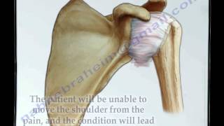 Frozen Shoulder  Everything You Need To Know  Dr Nabil Ebraheim [upl. by Fitz]