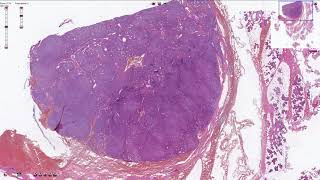 Basal Cell Adenoma  Salivary Gland Histopathology [upl. by Pax]