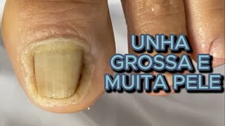 UNHA GROSSA E MUITA PELE satisfying viral [upl. by Novanod]