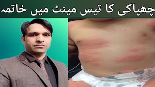 Urticaria homeopathic treatment  Urdu Hindi  چھپاکی کا ہومیو پیتھک علاجbesttreatment urticaria [upl. by Antoni]