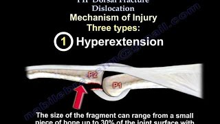 PIP Dorsal Fracture Dislocation  Everything You Need To Know  Dr Nabil Ebraheim [upl. by Tal48]