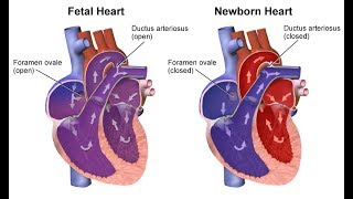 ¿Qué son las cardiopatías congénitas [upl. by Onder]