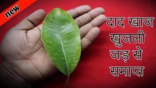 दाद खाज खुजली कितना भी साल पुराना हो 3 दिन में छुट्टी कर देगा  fungal infection on skin treatment [upl. by Schubert]