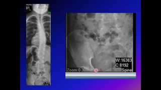 Cobb angle Scoliosis angle [upl. by Alebasi]