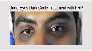 Under Eyes Dark Circle Treatment with PRP For Enquiry Contact 9700020802 [upl. by Iorgos]