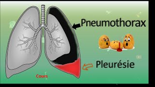 💨 Pneumothorax 🆚 Pleurésie 💧  Cours  PneumoPhtisiologie [upl. by Nednal]