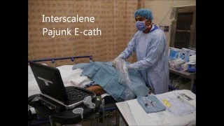 USG Interscalene Catheter Insertion Pajunk Ecath  OutOfPlane Technique [upl. by Hedva]