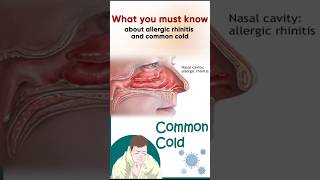 Allergic rhinitis and common coldPart1alergic cold commoncold rhinitis [upl. by Aihsemaj]