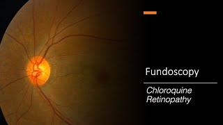 Chloroquine Retinopathy Fundoscopy [upl. by Volnak56]