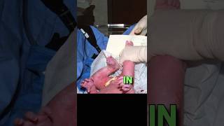 Rare phenomenon of subgaleal hemorrhage healthcondition Newborn [upl. by Yleoj]