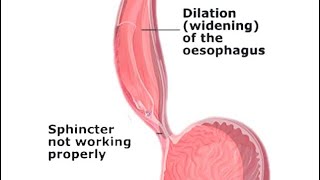 Mcqs on Achalasia cardianeetpg medicalstudent neetpgpreperation mbbssurgeryeducation [upl. by Allianora]