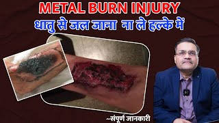 Metal Burn Injury  किसी भी गरम धातु से जल जाने से होता है थर्ड डिग्री बर्न  क्या है इसका इलाज [upl. by Nariko]