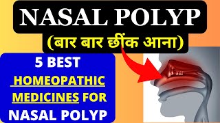 Nasal Polyps Treatment Miracle  Nasal Polyps Treatment Without Surgery  5 Homeopathy Medicine [upl. by Leifeste]