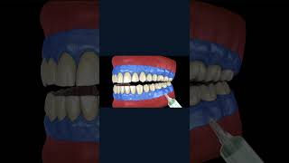 Teeth whitening lightactivation on tooth bleaching 3D animation concept [upl. by Isawk]