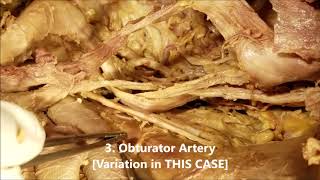 RIGHT INTERNAL ILIAC ARTERY Divisions Branches and Variation  Sanjoy Sanyal [upl. by Bancroft]