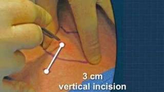 Cricothyrotomy [upl. by Analihp]