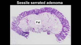 Serrated polyps Learn to tell the difference between hyperplastic polyp and sessile serrated lesion [upl. by Rola]