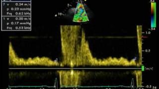 REVERSE DIASTOLIC FLOW  DESCENDING AORTA [upl. by Llewon]